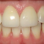 1_Upper Arch