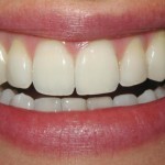 after Invisalign and whitening
