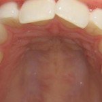 crooked upper front teeth