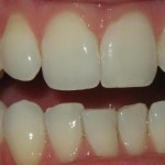 crowded front teeth