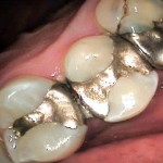 unsightly siler fillings