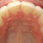 upper front teeth after Invisalign